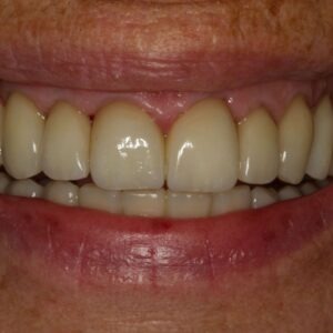 Diastema dentale