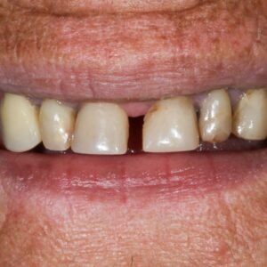 Diastema dentale