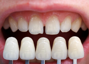 Faccette dentali a Udine | usura dei denti